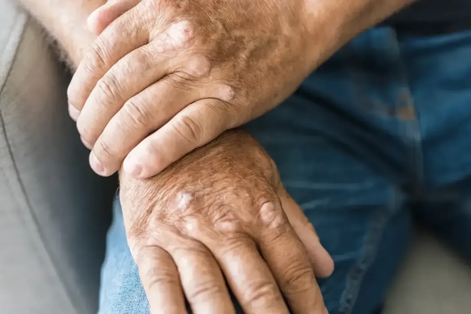 Arthritis